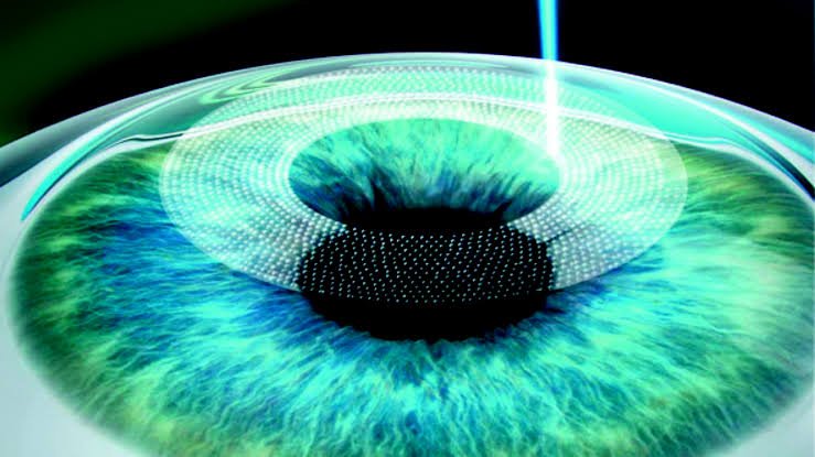 Femto LASIK iris