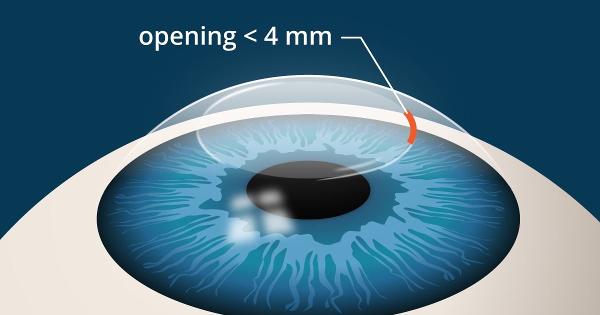 SMILE LASIK small incision diagram